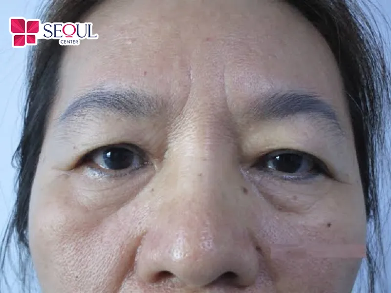 Những ai có mí mắt bị chùng, sụp mí, da thừa nhiều, chảy xệ, bọng mỡ thừa nhiều,...rất phù hợp Cắt Mí Trên
