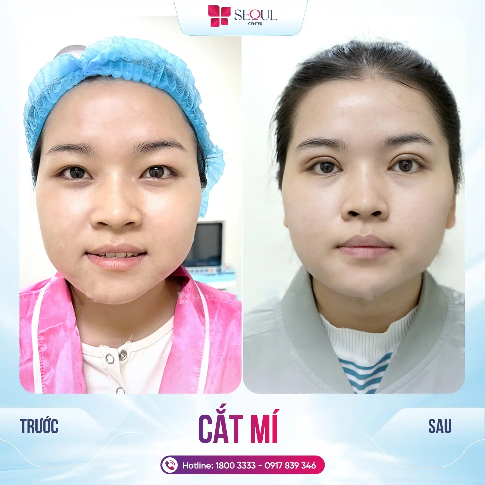 Sau khi cắt mí trên cô gái đã sở hữu được đôi mắt to tròn, long lanh