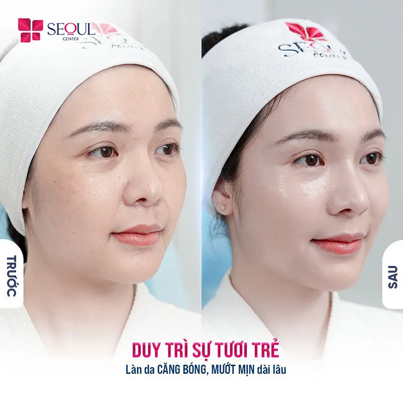 Liệu trình Intafill Căng Bóng sở hữu nhiều ưu điểm được nhiều chị em yêu thích
