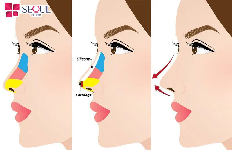 Nâng mũi bằng sụn tai kết hợp sụn nhân tạo cho kết quả tự nhiên, hài hòa đường nét gương mặt