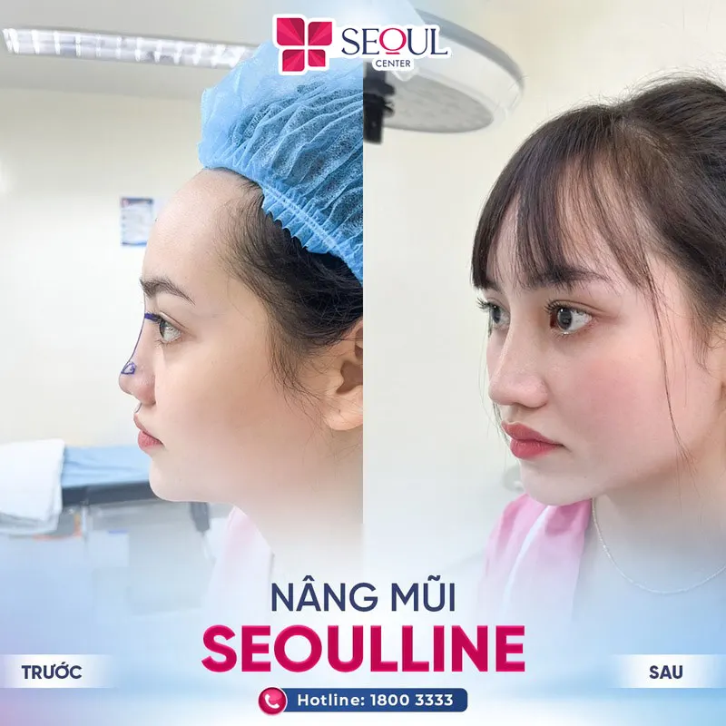 Dáng mũi mới tự nhiên, hài hòa với đường nét gương mặt
