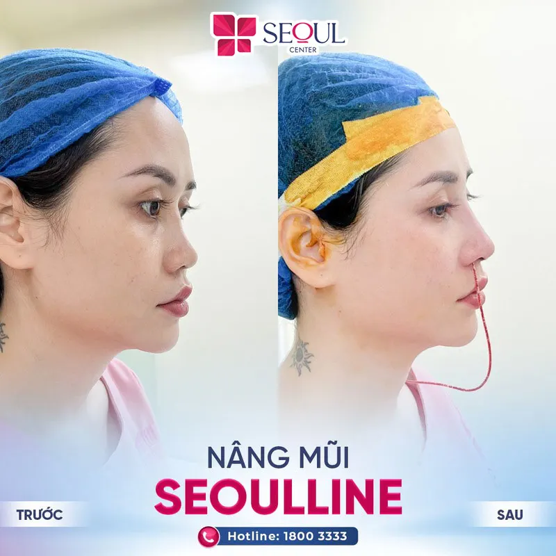 Mũi cao thẳng tự nhiên ở mọi góc nhìn tạo điểm nhấn cho khuôn mặt