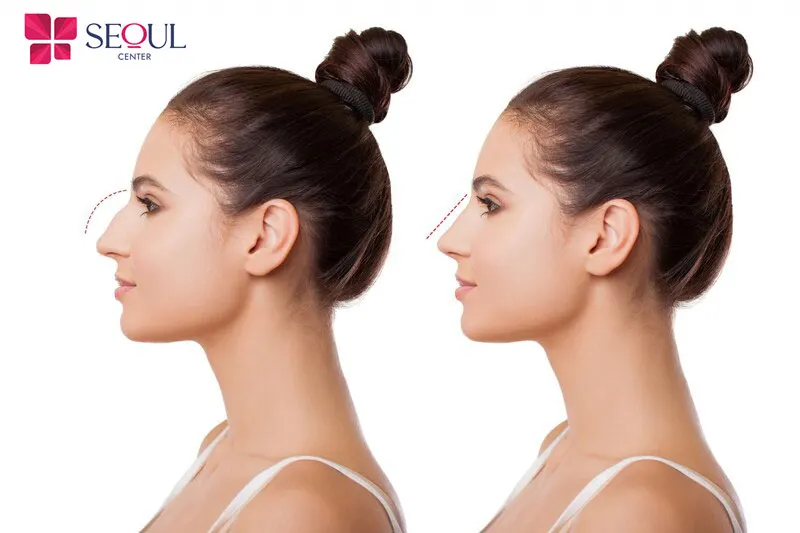 Nâng mũi bằng sụn tai cho độ bền thẩm mỹ lâu dài lên đến 20 năm