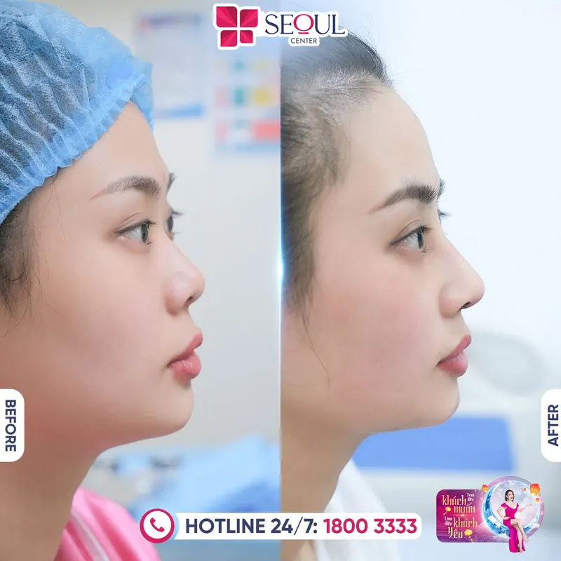 Các khuyết điểm của mũi được cải thiện, cho nhan sắc thêm rạng rỡ