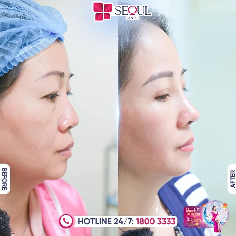 Nâng mũi sụn tai an toàn, tránh các biến chứng có thể xảy ra