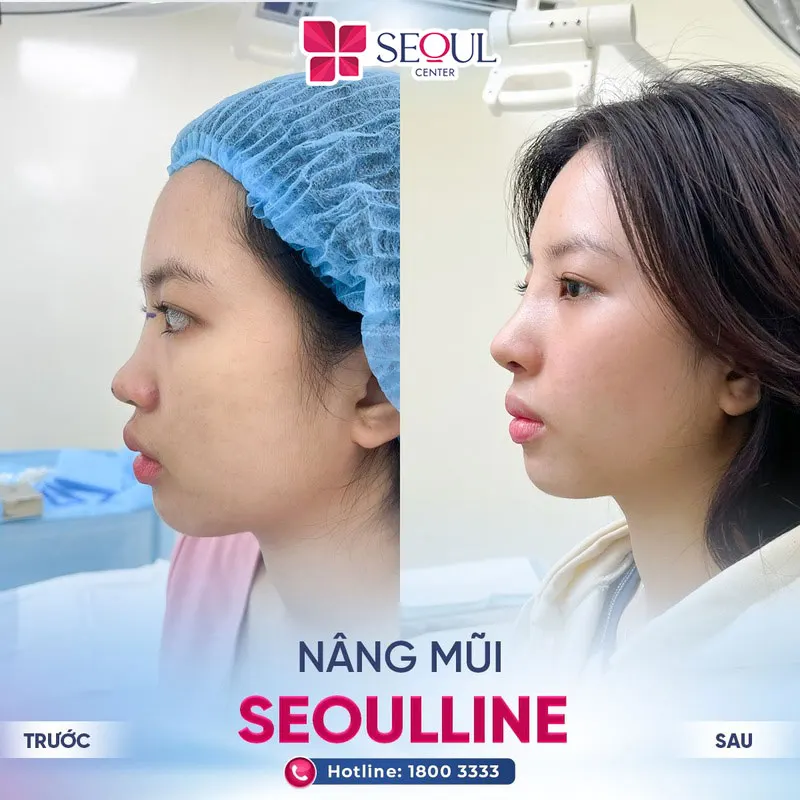 Khách hàng thêm phần tự tin về ngoại hình sau ca nâng mũi tại Seoul Center