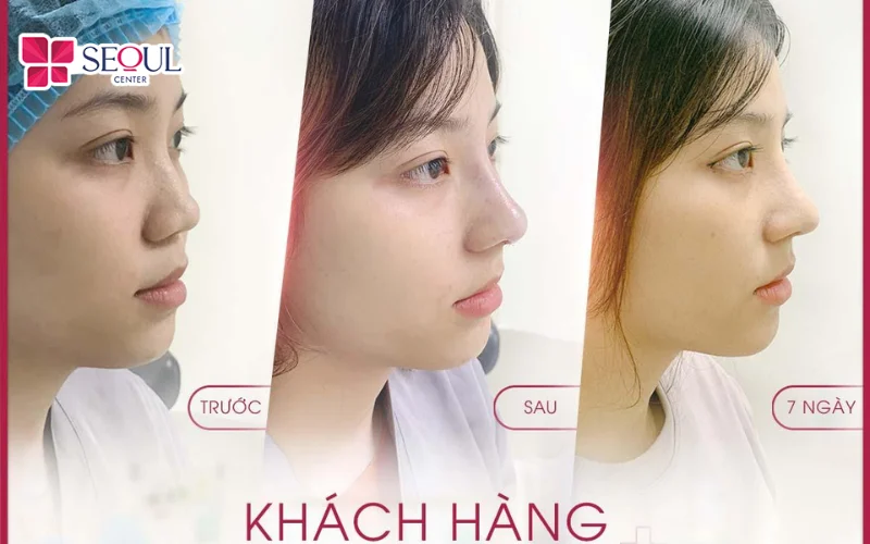 Các khuyết điểm trên mũi đều được chỉnh sửa thành công tạo ra dáng mũi mới hoàn hảo