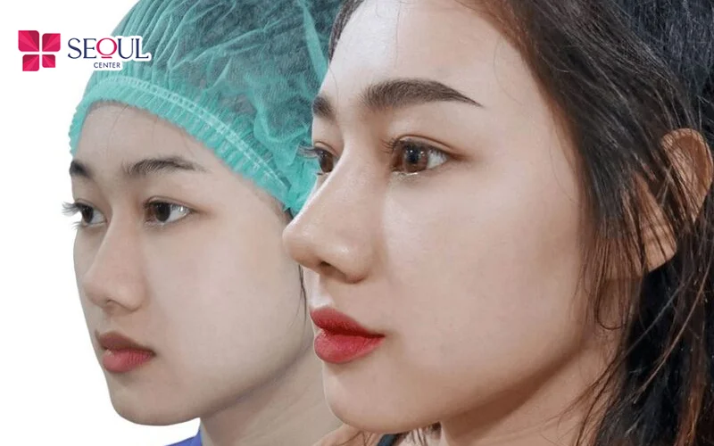 Chiếc mũi sau khi thực hiện tiểu phẫu hoàn hảo, không để lại sẹo