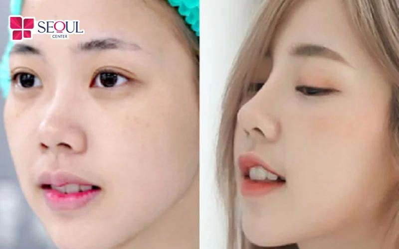 Chiếc mũi đẹp giúp các đường nét trên gương mặt cân đối, hài hòa hơn