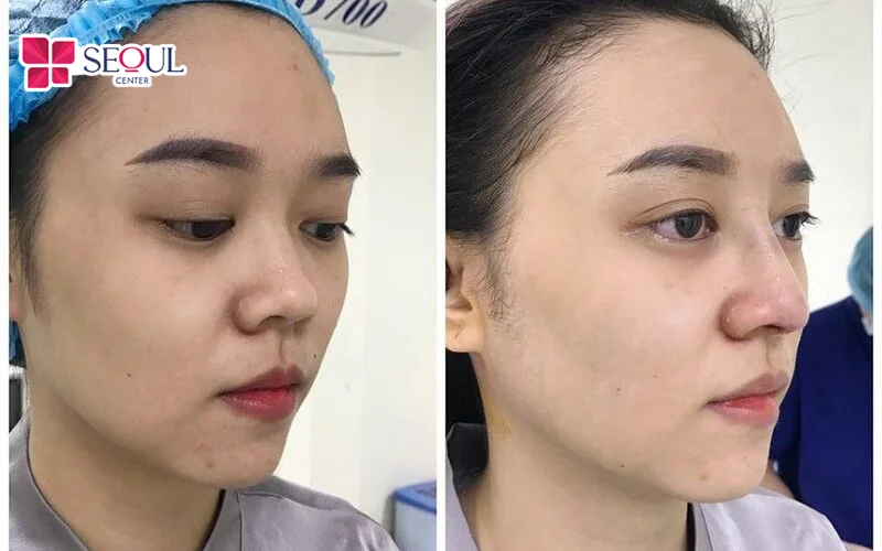 Đường sống mũi cao, lỗ mũi kín, đầu mũi dáng tam giác là vẻ đẹp nhiều chị em yêu thích