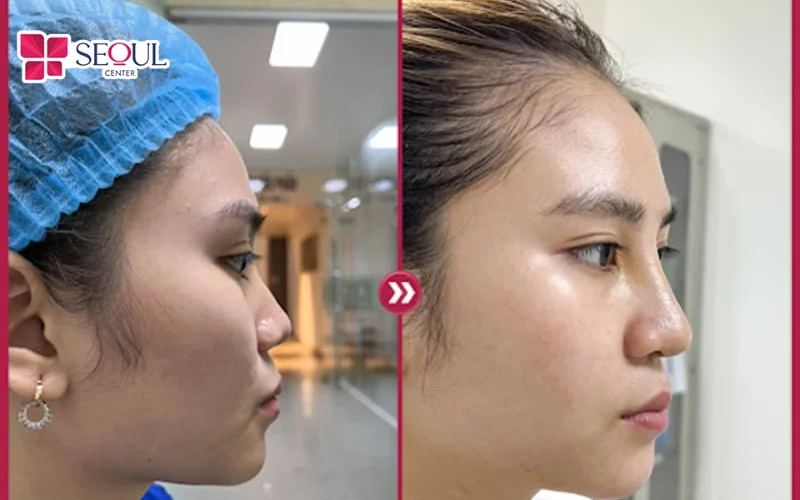 Tạo hình dáng mũi thon gọn giúp bạn sở hữu chiếc mũi đẹp đúng tiêu chuẩn