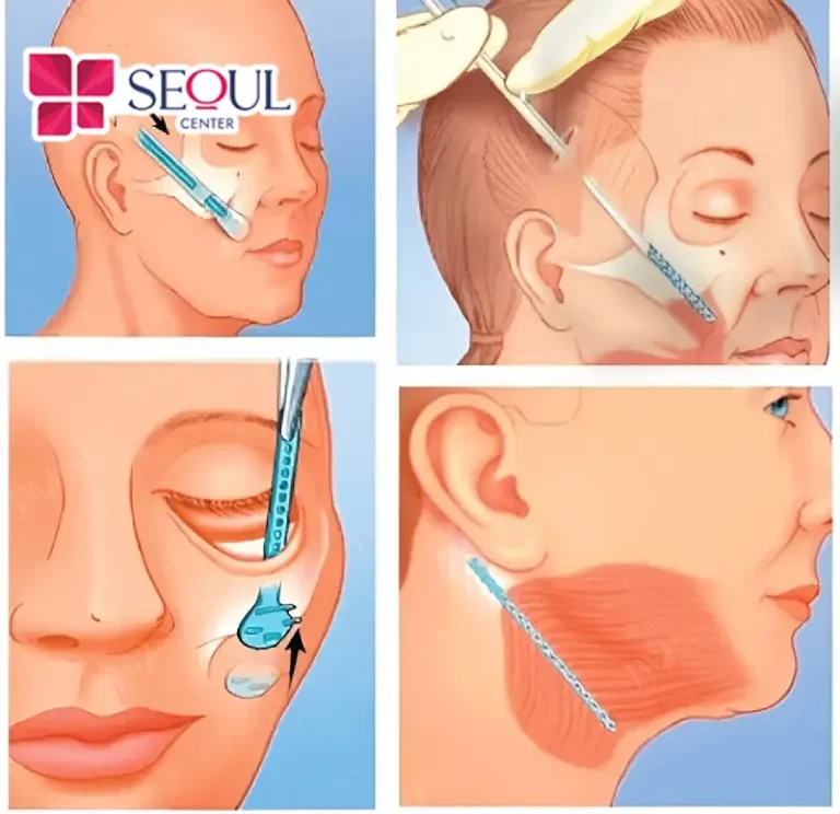 Căng Da Midface là phương pháp thẩm mỹ can thiệp từ dưới mí mắt đến khóe miệng giúp trẻ hóa diện mạo