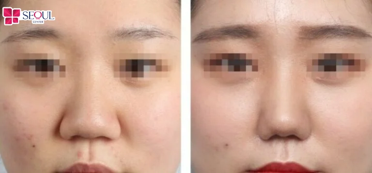 Tùy vào khuyết điểm mũi mỗi người sẽ thực hiện phương pháp thẩm mỹ khác nhau