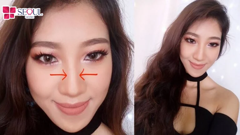Đánh khối mũi là biện pháp che đi cánh mũi thô to
