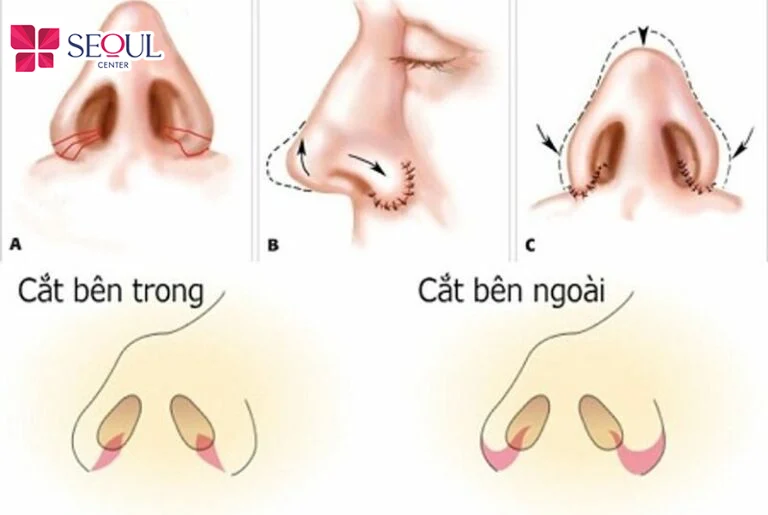 Kỹ thuật cắt cánh mũi khắc phục tình trạng cánh mũi to bè