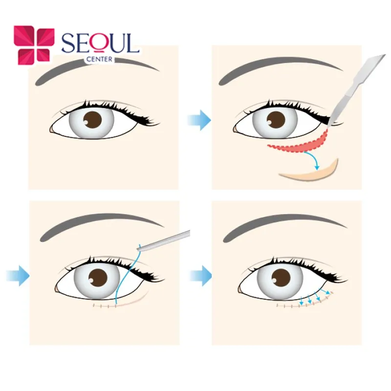 Cắt Mí Dưới là tiểu phẫu loại bỏ bọng mắt, nếp nhăn vùng mi mắt dưới giúp đôi mắt trẻ trung, săn chắc