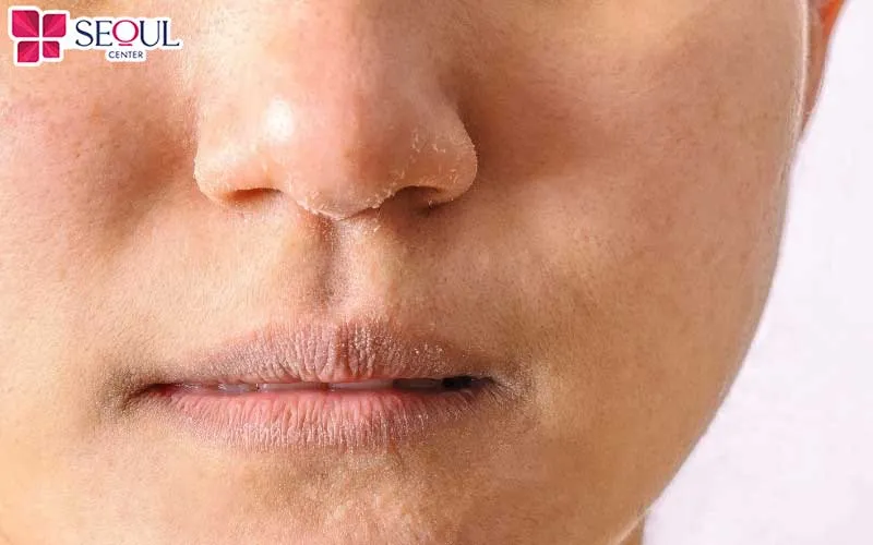 Người có làn da khô, thâm sạm và xỉn màu là đối tượng phù hợp có thể cân nhắc thực hiện chăm sóc da cao cấp Infusion