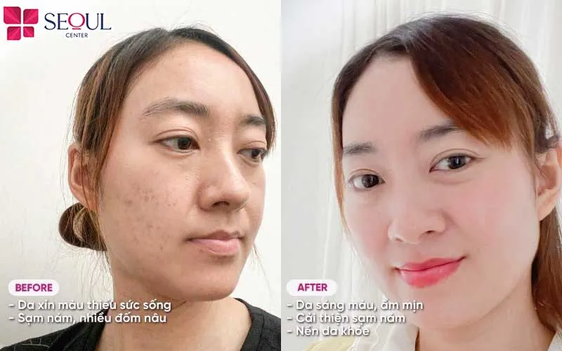 Nền da khỏe, căng bóng và mịn màng hơn sau khi hoàn thiện liệu trình chăm sóc da cao cấp Infusion tại Seoul Center