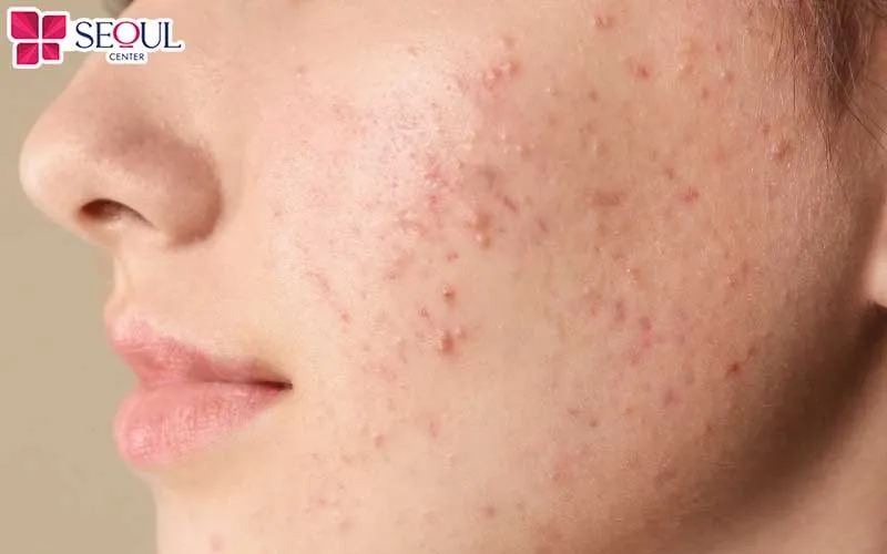 Chuyên gia sẽ đánh giá tình trạng mụn cụ thể của khách hàng và tư vấn liệu trình chăm sóc da phù hợp