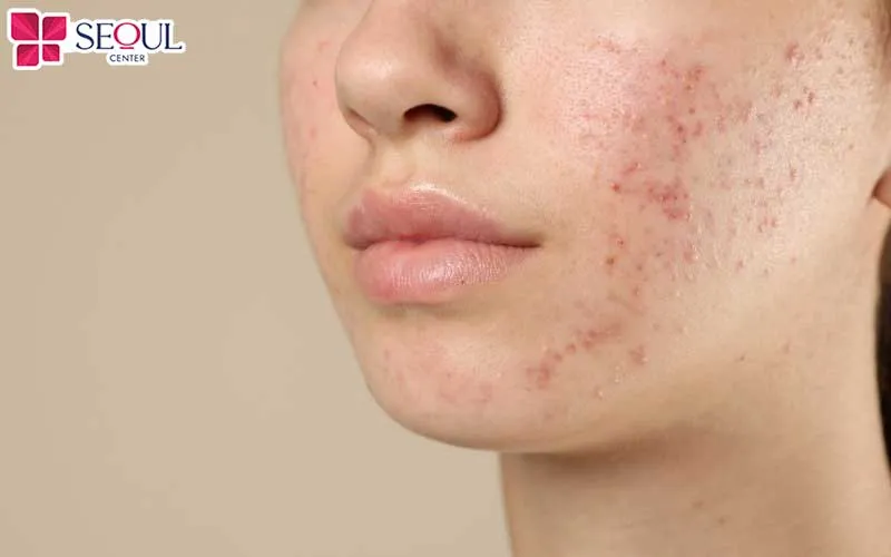 Chuyên gia sẽ thực hiện kiểm tra và đánh giá tình trạng mụn cụ thể trước khi thực hiện liệu trình HA Peptide