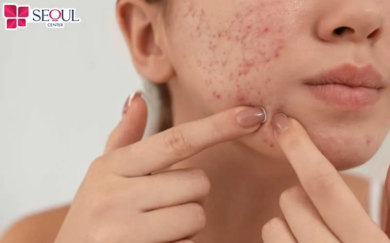 Da đang có mụn viêm cấp tính, viêm nhiễm nên tạm hoãn liệu trình chăm sóc da HA Peptide cho đến khi da ổn định và hồi phục