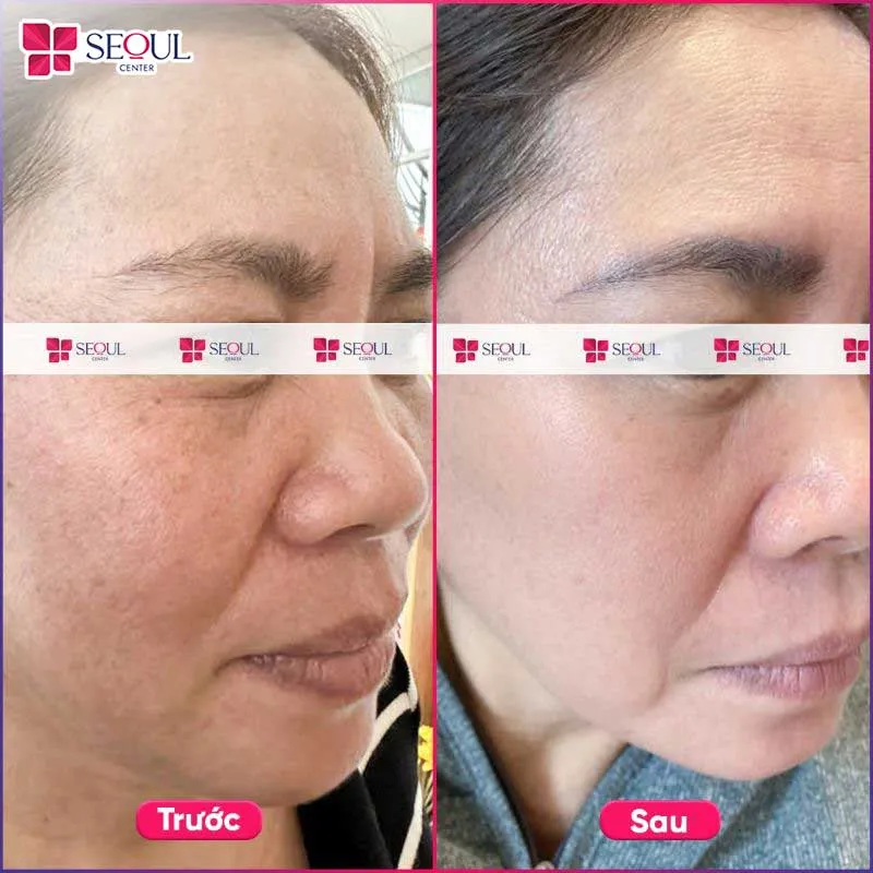 Tình trạng da khô ráp, xỉn màu gần như được cải thiện rõ rệt khi duy trì liệu trình chăm sóc da HA Peptide