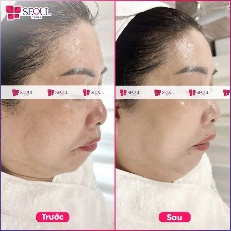 Da căng bóng, ẩm mịn và đều màu hơn khi duy trì liệu trình HA Peptide theo đúng phác đồ của chuyên gia