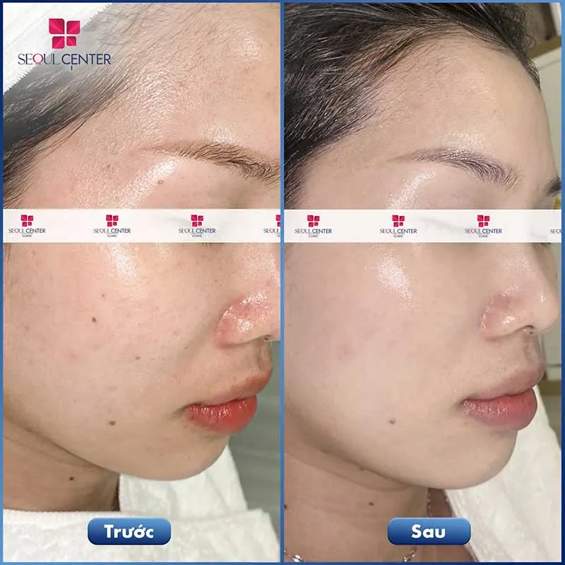 Làn da cô gái phục hồi, ẩm mịn và khỏe khoắn hơn sau khi chăm sóc da Luxury