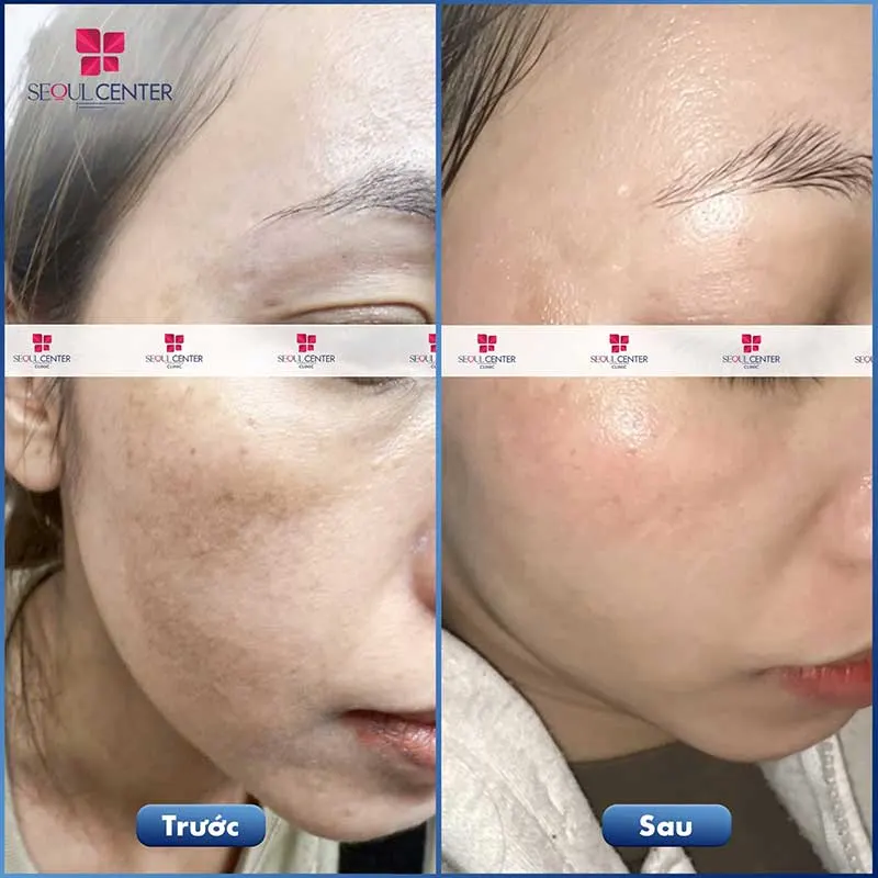 Da chị khách sạm, xỉn màu, khô ráp, thiếu ẩm đã được khắc phục sau khi sử dụng liệu trình chăm sóc da Luxury tại Seoul Center