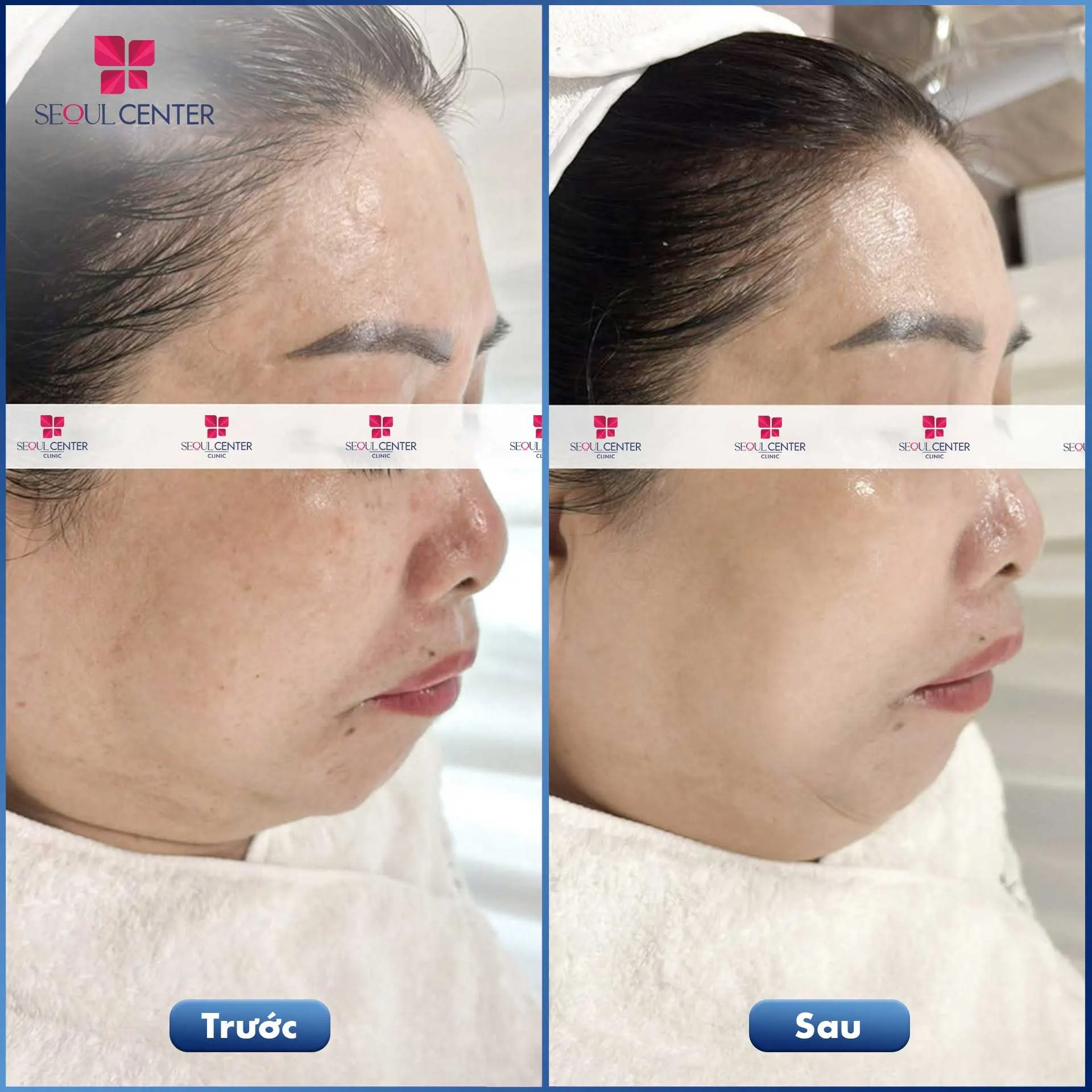 Tình trạng da sạm, khô, kém sắc của chị khách đã được khắc phục sau liệu trình chăm sóc da Luxury