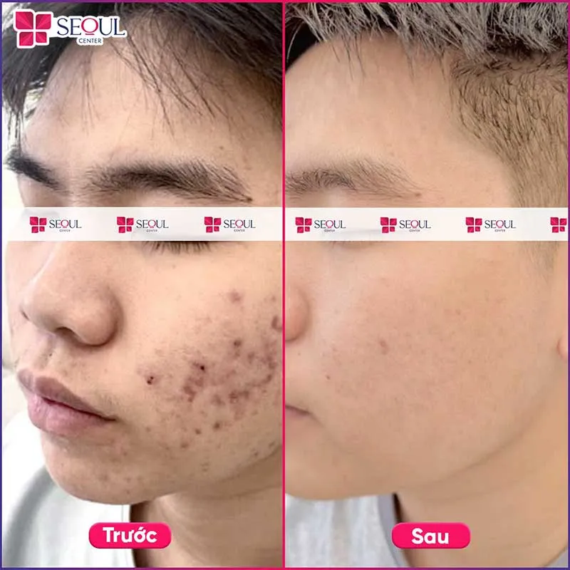 Hình ảnh trước và sau khi khách hàng sử dụng dịch vụ chăm sóc da Vitamin C tại Seoul Center Hình ảnh trước và sau khi khách hàng sử dụng dịch vụ chăm sóc da Vitamin C tại Seoul Center