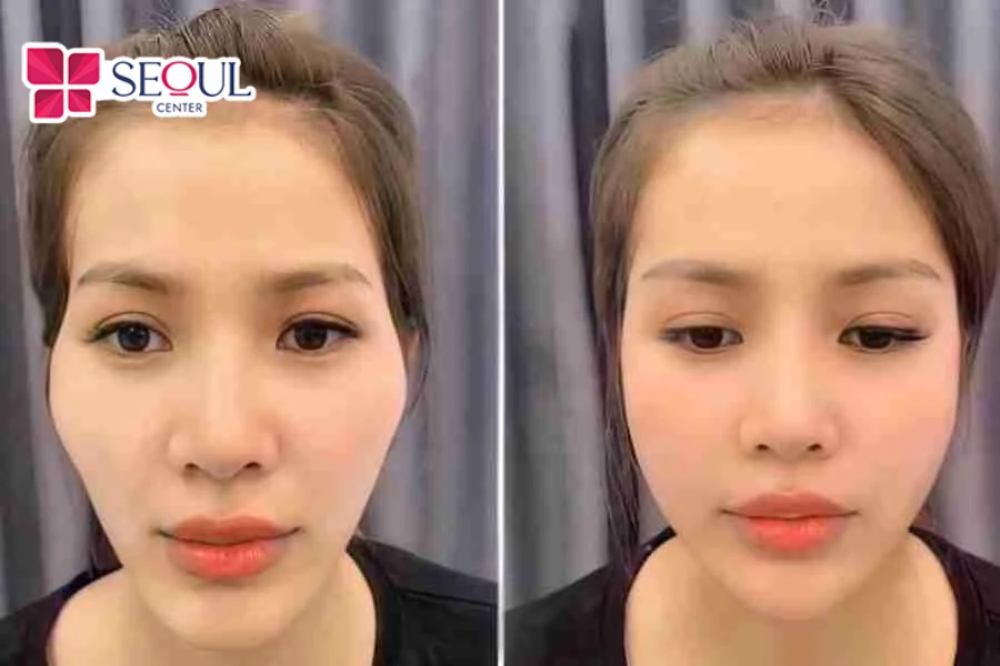 Thời điểm tiêm filler phù hợp là sau sạch kinh 1 tuần, sức khỏe ổn định, da lành lặn, khỏe mạnh, không bị viêm nhiễm hay có vết thương hở