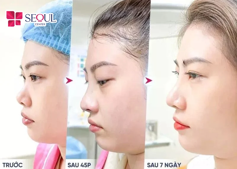 Nâng mũi là phương pháp cải thiện mũi xấu tối ưu, duy trì hiệu quả bền vững