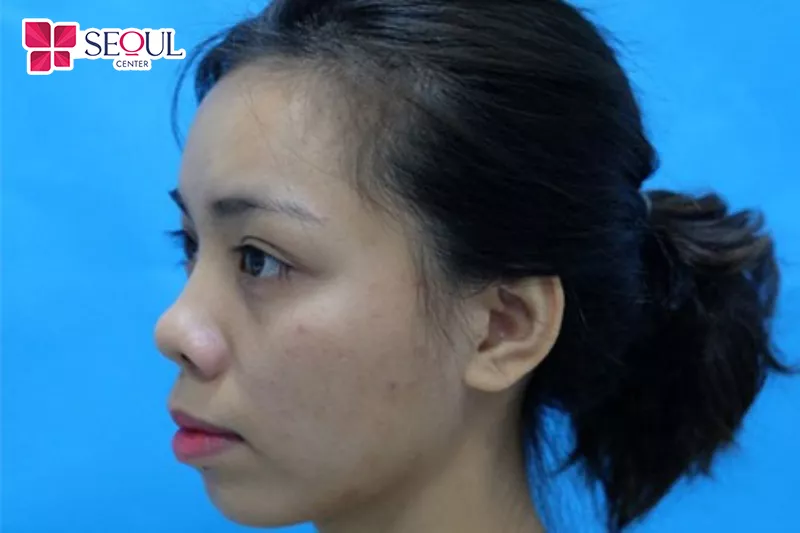 Mũi hếch là một trong những dáng mũi dễ bắt gặp ở người Châu Á, đặc biệt là Việt Nam