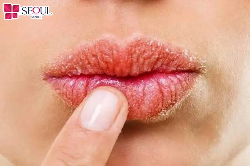 Có nhiều nguyên nhân khác nhau gây ra tình trạng dị ứng thuốc tê khi xăm môi