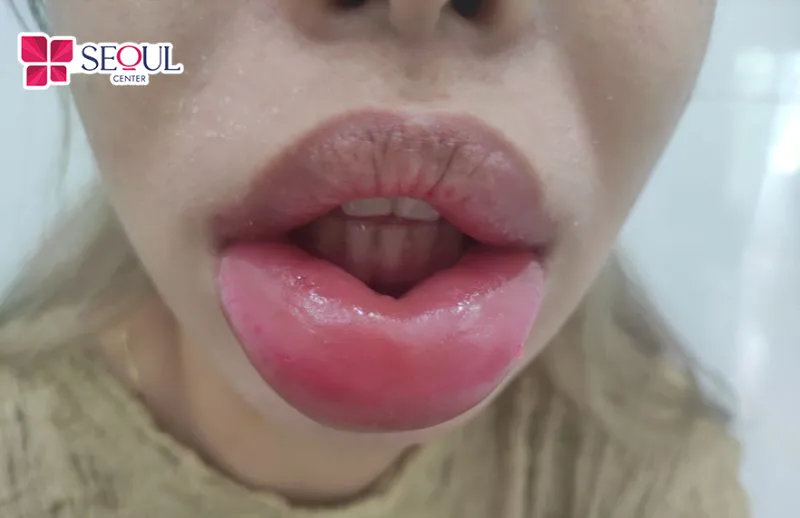 Vùng môi có thể xuất hiện tình trạng sưng sau tiêm filler do phản ứng tự nhiên của mô da.