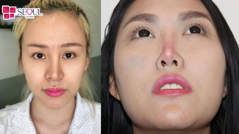 Tháo sụn để điều chỉnh lại dáng mũi không như ý