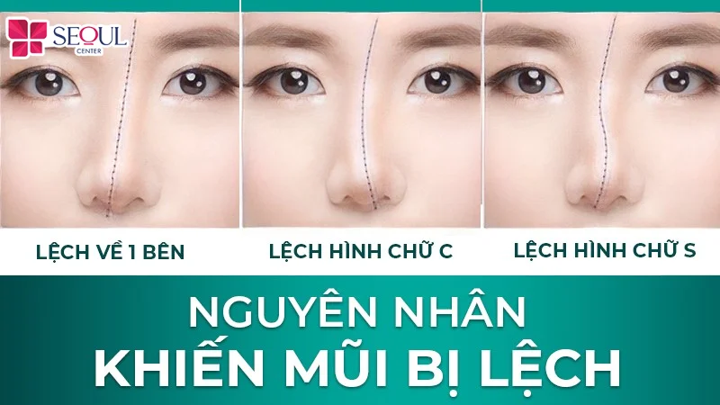 Mũi bị lệch, vẹo sau nâng có thể cần tháo sụn để bác sĩ kiểm tra, điều chỉnh cấu trúc và cải thiện độ cân đối của dáng mũi.
