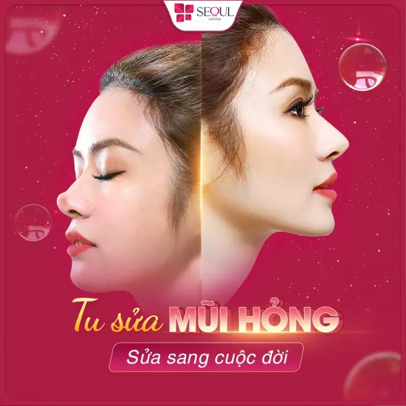 Hình ảnh sau khi tháo sụn mũi, sửa dáng mũi mới tại Seoul Center
