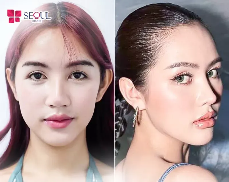 Tháo sụn khắc phục lộ sống mũi