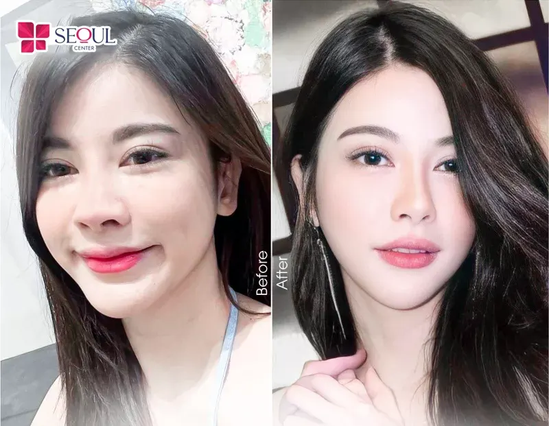 Tháo sụn mũi khắc phục trình trạng nâng mũi không ưng ý