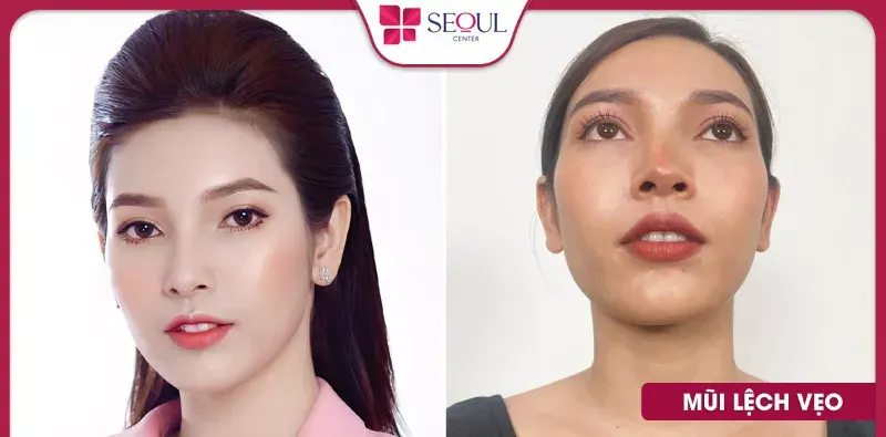 Tháo sụn mũi khắc phục tình trạng mũi lệch