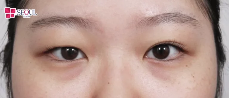 Những ai có nếp rẻ quạt che một phần mắt khiến mắt trông nhỏ, kém thẩm mỹ rất phù hợp thực hiện dịch vụ Mở Rộng Góc Mắt