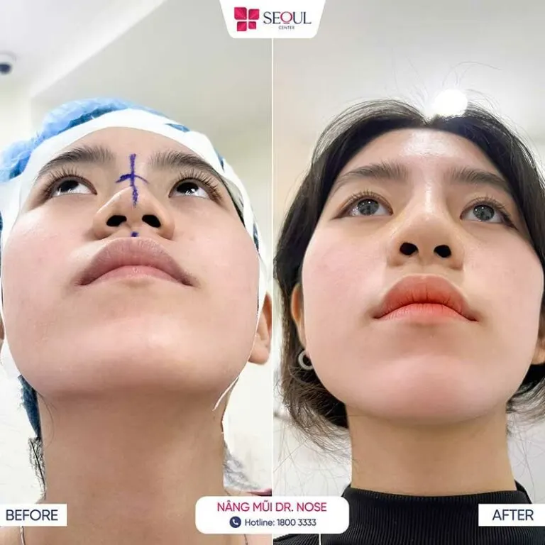 Hình ảnh khách hàng trước và sau khi nâng mũi khắc phục dáng mũi sư tử tại Thẩm mỹ viện Seoul Center