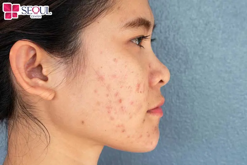 Những ai có da thâm xỉn màu, viêm nhẹ có thể áp dụng dịch vụ Mụn DermaPerfecta+ để điều trị
