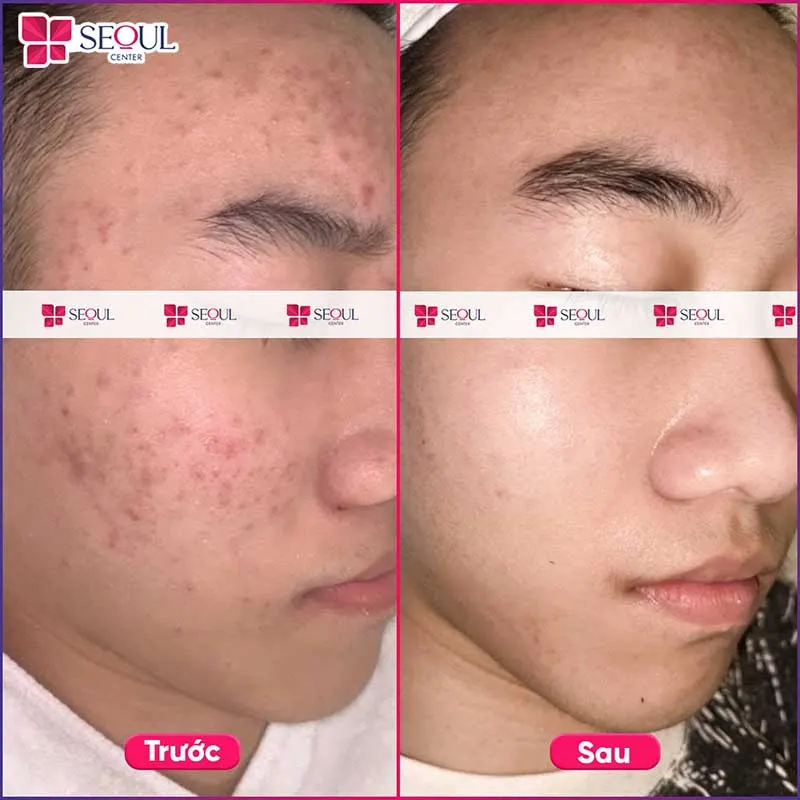 Da khách hàng thâm mụn, xỉn màu, viêm nhẹ đã được điều trị hiệu quả sau liệu trình Mụn DermaPerfecta+ tại Seoul Center