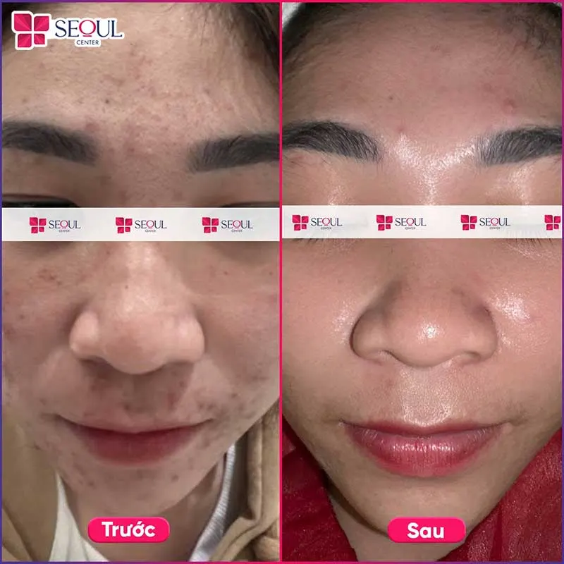 Tình trạng thâm, viêm, da xỉn màu của khách hàng đã được thuyên giảm sau khi điều trị mụn tại Seoul Center