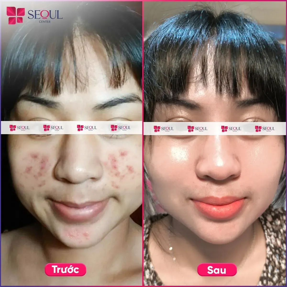 Liệu trình Điều trị mụn E2X phù hợp với những ai có mụn cấp độ nhẹ đến trung bình