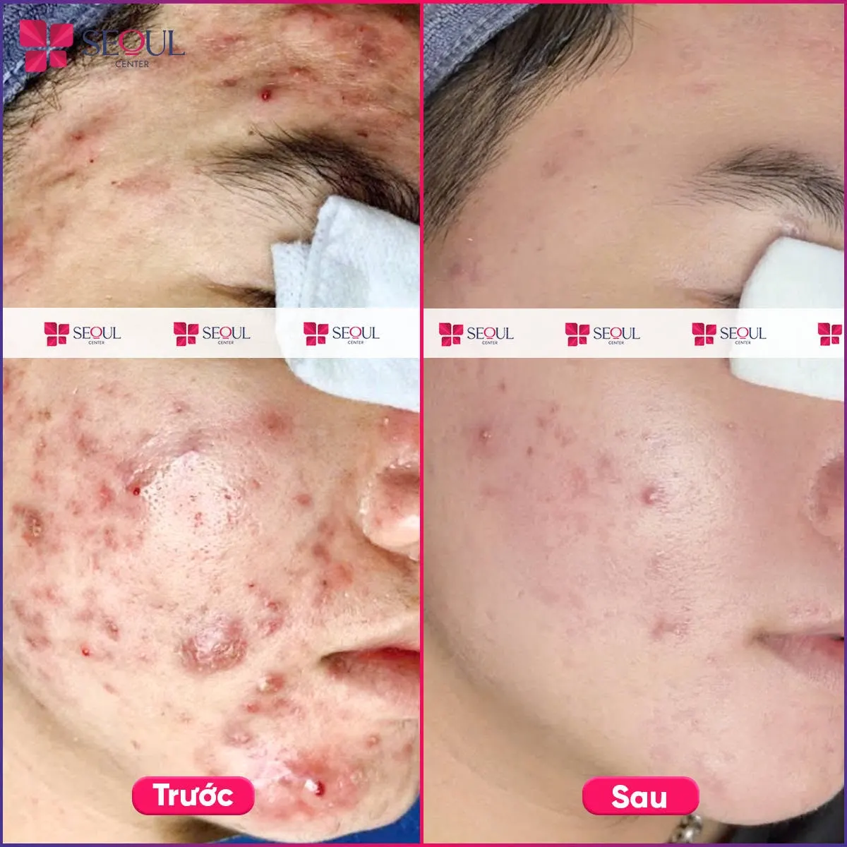 Tình trạng mụn của khách hàng thuyên giảm đáng kể sau khi điều trị mụn E2X