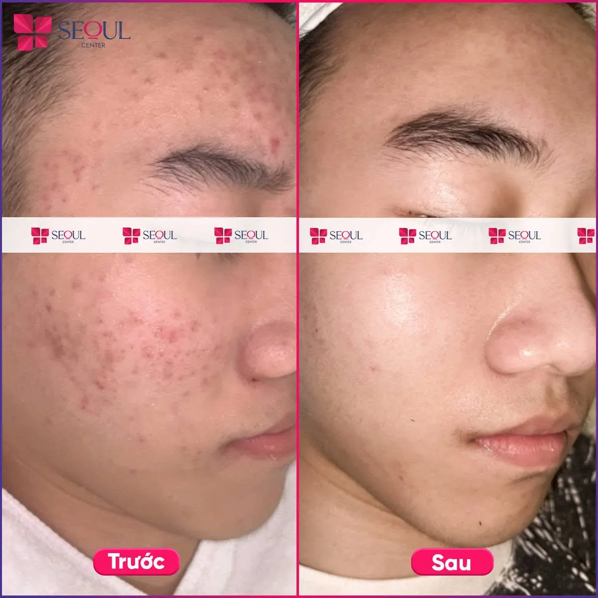 Da láng mịn, giảm mụn hơn sau liệu trình điều trị mụn E2X